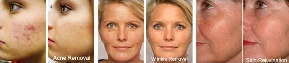 Before and after results of using red light therapy to treat the skin